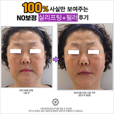 시술후기