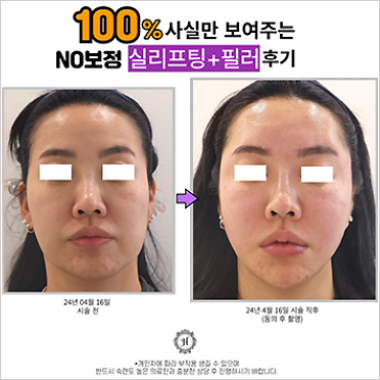 시술후기