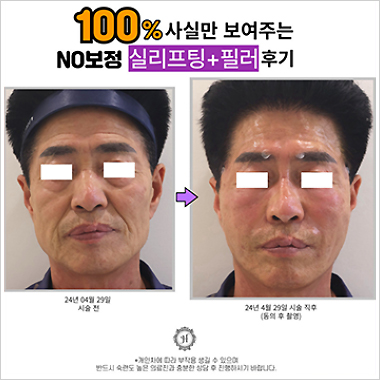 시술후기
