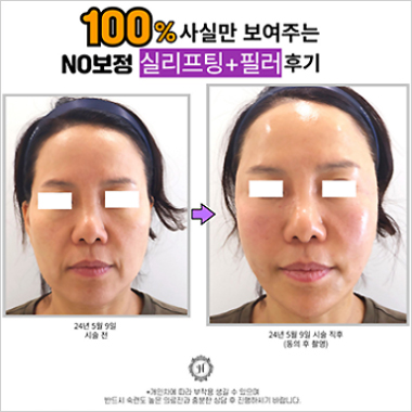 시술후기