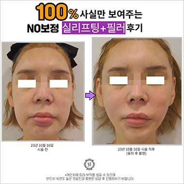 시술후기