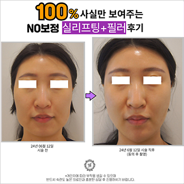 시술후기