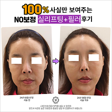 시술후기