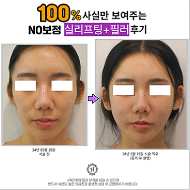 시술후기